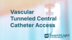 Vascular Tunneled Central Catheter Access