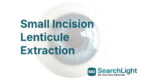Small Incision Lenticule Extraction