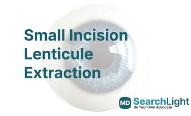 Small Incision Lenticule Extraction